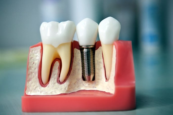 стоматология имплантация зуб