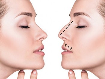 ринопластика нос