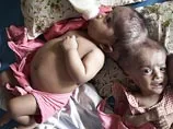 Австралийские хирурги разделяют сиамских близнецов, сросшихся головами