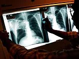 Исследование: некоторые люди генетически невосприимчивы к туберкулезу